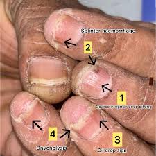Image result for Pitting nails feet