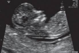 This scan measures a tiny bit of fluid located behind the baby's neck, known as nuchal translucency. First Trimester Screening Non Invasive Prenatal Testing