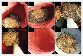 Image result for Bezoar