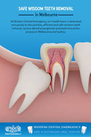 At Wisdom Dental Emergency Our Health Team Is Dedicated Exclusively To The Painless Efficient And Safe Wi Dental Emergency Wisdom Teeth Wisdom Teeth Removal