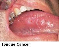 This represents the size of the main tumor, and indicates how far the tumor has grown inside the throat and in nearby tissue areas. Ear Nose Throat Sinus Specialists Dr Edgar Lueg Ventura Ca Head Neck Tumors