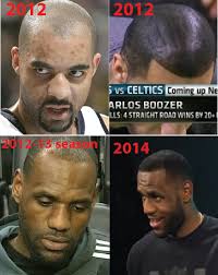 DID LEBRON HAVE HAIRLINE FIXED?!