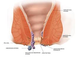 ¿cómo se produce una trombosis hemorroidal externa? Como Tratar Las Hemorroides Dr Alberto Parajo Coloproctologo