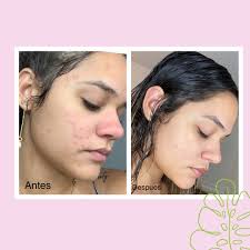 Peelings químicos Si tienes acné te podemos ayudar. 787-989-2555/2557 DM  para más Info.