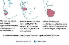 Incorrect Swallow Will Cause Facial Speech Swallowing And Breathing Difficulties From Orthotropics Myofunctional Therapy Tongue Thrust Orofacial Myology
