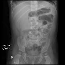 Image result for Intussusception