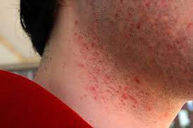 How To Prevent Razor Burn | The Art Of Manliness