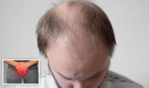 It is a very common cause. Hair Loss Patchy Bald Spots Could Regrow Hair If An Underlying Sti Is Treated Express Co Uk
