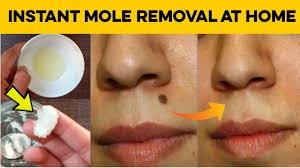 How To Remove Moles On Face Quickly Natural Home Remedy To Remove Mole In 2020 Moles On Face Mole Removal Mole Removal At Home