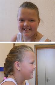 Photographs of the patient when she was 11 years old. Note,...