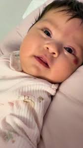 My perfect little baby 💕🥰 #hemangiomababy #infantilehemangioma #fypシ...