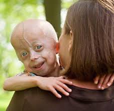 Image result for progeria case in bihar