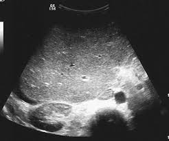 Although puncture and aspiration can improve the symptoms of . Budd Chiari Syndrome In Pleural Mesothelioma Springerlink