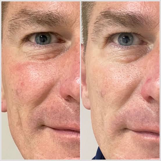 Sunekos Performa Treatment in Berkhamsted | Koha Clinics