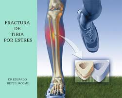 Maybe you would like to learn more about one of these? Fractura De Tibia Por Estres Cirugia De Columna En Matamoros