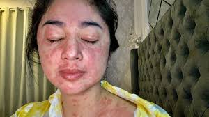 Dear Warganet Ruam Merah Yang Dialami Dewi Persik Adalah Gejala Covid 19