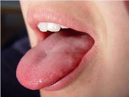 Image result for cancer of tongue