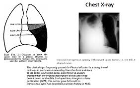 Ellis S Shaped Curve For Pleural Effusion Respiratory System Medical Studies Pleural Effusion