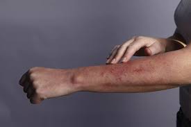 Group a coxsackieviruses were noted to cause a flaccid paralysis (which was caused by generalized myositis) while group b coxsackieviruses were noted to cause a spastic paralysis (due to focal muscle injury and degeneration of neuronal tissue). Was Ist Ein Mono Ausschlag