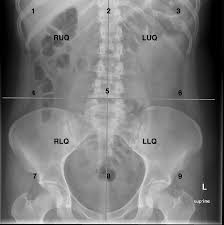 The median plane, also known as the midsagittal plane, divides the left and right quadrant. Approach To The Abdominal X Ray Axr Undergraduate Diagnostic Imaging Fundamentals