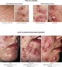 These lesions are signs of inflammation in the deep layers of the skin. Acne Rosacea And Related Disorders Plastic Surgery Key