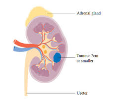 Kidney Cancer Symptoms Diagnosis Treatment Urology