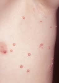 Här kan du hitta vaccinatör för bältrosvaccin. Mollusker 1177 Vardguiden