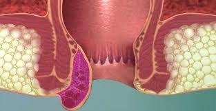 علاج البواسير الخارجية طبيعيا بدون جراحة Hemorrhoids Hemorrhoids Treatment Bleeding Hemorrhoids