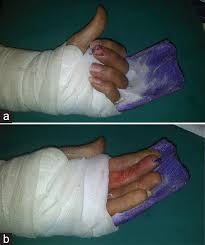 Strickland described the ideal repair as having the following characteristics: Results Of Flexor Tendon Grafting With Early Active Mobilization El Mowafy Hm Neanaa Ha Ahmed Ma Menoufia Med J