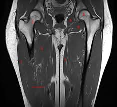 The muscles of the thigh are arranged into three compartments. Mri Of The Thigh Detailed Anatomy Superior Part W Radiology