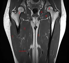 Related posts of muscle anatomy of upper thigh. Mri Of The Thigh Detailed Anatomy Superior Part W Radiology