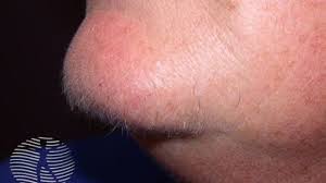 Background up to 5% to 10% of women are hirsute (hair in areas where normally only men have hairs such as moustache, beard area, chest, belly, back etc). Treating Hirsutism In Women With Pcos