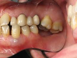 Maybe you would like to learn more about one of these? Dampak Negatif Gigi Hilang Tidak Diganti Gigi Palsu Audy Dental