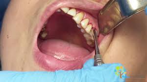 May 25, 2021 · wiggle the tooth. Surgical Tooth Extraction Warning Extreme Decay Beneath Crown Youtube