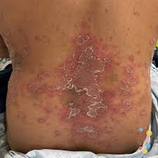 Image result for psoriasis