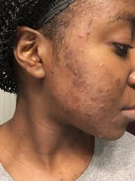 The body shop tea tree oil contains a skincarisma flagged allergen. Review The Body Shop Tea Tree Skin Cleansing Face Wash Lakisha Adams