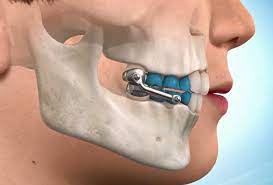 The Patient S Guide To The Herbst Appliance Premier Orthodontics