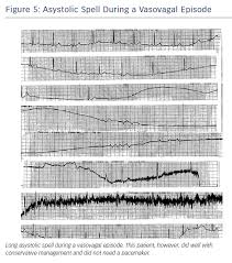 How to spell episode, correct spelling of episode, how is episode spelled, spell check episode, how do you spell episode. Figure 5 Asystolic Spell During A Vasovagal Episode Aer Journal