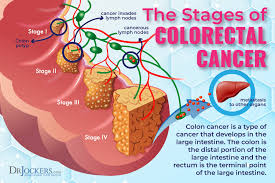 Maybe you would like to learn more about one of these? Colon Cancer Symptoms Causes And Support Strategies