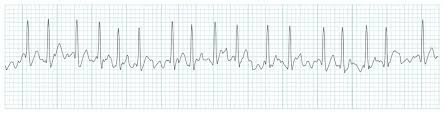 Image result for Atrial Flutter