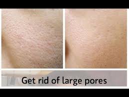 How To Get Rid Of Large Pores On Face Nose Cheeks Large Pores Nose Pores Blackheads On Cheeks