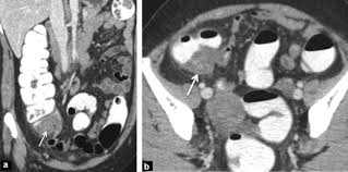 Symptoms of diverticulitis and colon cancer may include abdominal pain. Appendicitis And Diverticulitis Of The Colon Misleading Forms Sciencedirect
