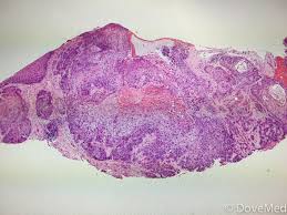 What does squamous cell cancer look like? Squamous Cell Carcinoma Of Lip