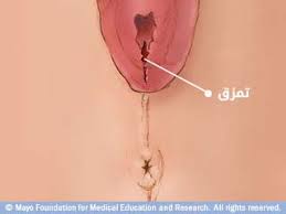 بالصور تمزق المهبل بعد الولادة ويب طب