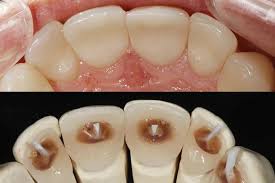 Vereinbaren sie einen kurzfristigen kontrolltermin. Veneers 0 25mm Made In Munchen Dr Rudiger Hansen