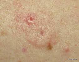 With early detection and treatment, almost all basal cell carcinomas (bccs) can be successfully removed without complications. Basal Cell Carcinoma