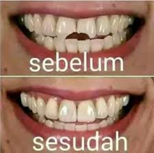 Dokter gigi distya ramadani siap mewujudkan keinginan anda yang ingin memiliki gigi palsu atau pasang behel (kawat gigi). Jasa Pasang Gigi Palsu Murah Berkualitas
