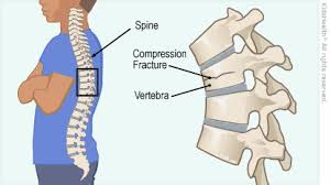 Backbone makes it easy to move through the app quickly without the reloading of scripts and embedded videos. Vertebral Compression Fractures Advanced Pain Management Center Interventional Pain Management Physician