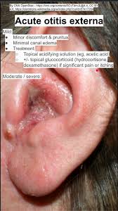 Image result for Acute Otitis Externa