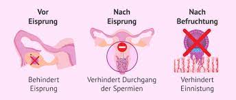 Nach der einnahme des präparats ist eine zusätzliche verhütung mit kondom bis zur nächsten monatsblutung wichtig. Die Pille Danach Wirkungsweise Und Kosten